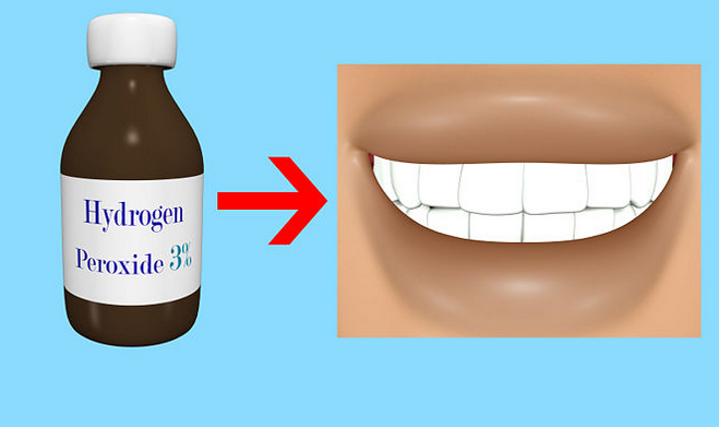 تبييض الأسنان مع بيروكسيد الهيدروجين