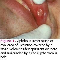   التقرحات الفموية الصغيرة (Minor Apthous Ulcer): وهي الأكثر شيوعا وتحدث عادة في الجزء الأمامي وحجمها اقل من ١٠ مم.