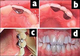(a) A simple cantilever bridge is the preferred design but a fixed-fixed design (b) may be necessary if orthodontic tooth movements to create space for the prosthesis are not stable. Note the