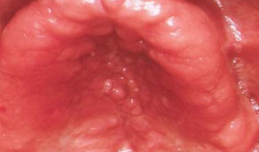 صورة (2) التهاب الفم المسبب بالأجهزة _ النمط 2 _