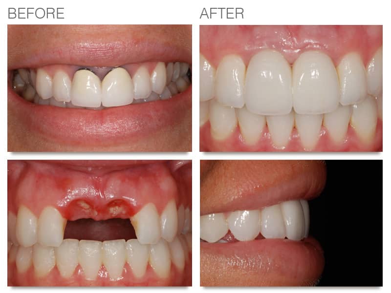 Dental Implants | Prosthodontist