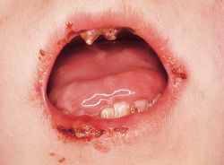 epidermolysis bullosa تأثيره على الفم والاسنان