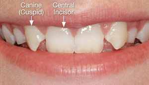 missing-lateral-incisors