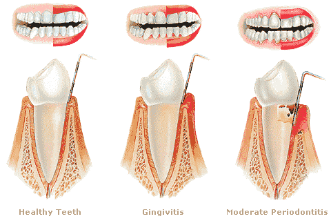 امراض اللثة - والم الاسنان