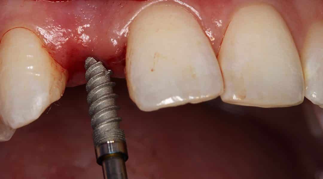 عملية الزرع السني صور توضيحية  Implant case