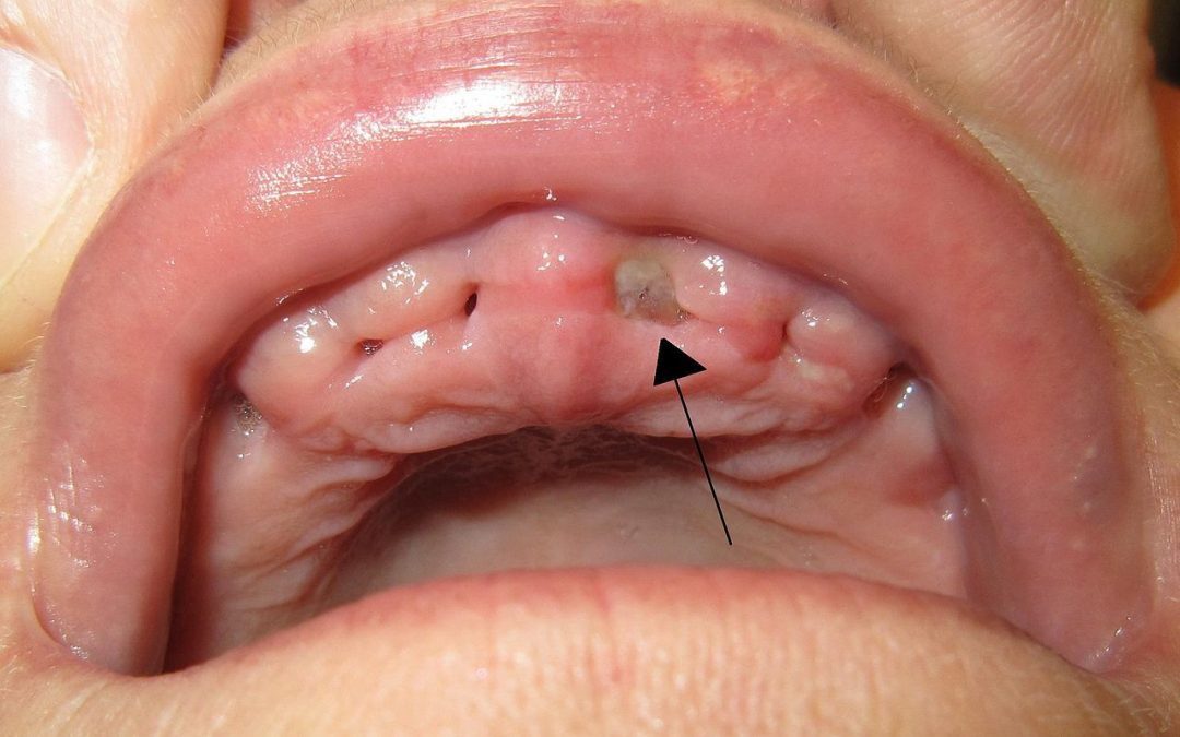 التهاب السنخ الجاف Alveolar osteitis