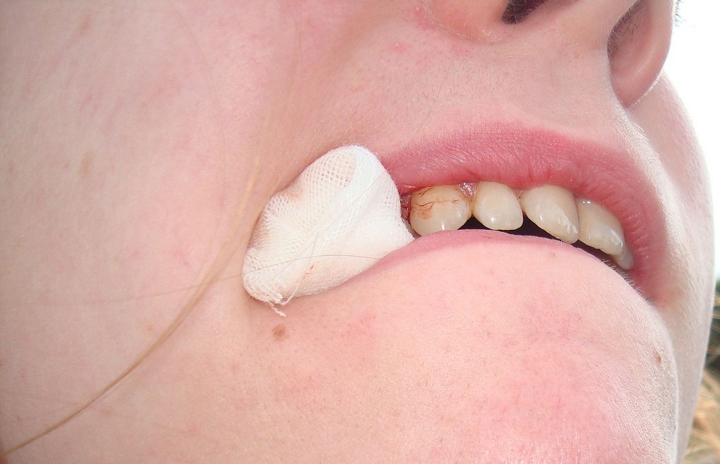 ١٠ أشياء لا تفعلها بعد قلع أسنانك (After extraction)