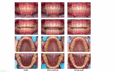 ترميم الأسنان المسحولة worn dentition بالكومبوزت المباشر direct composite