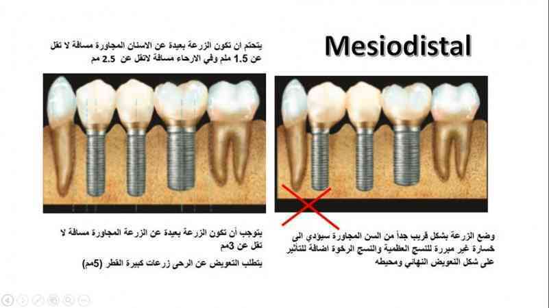 شرائح في زرع الاسنان #Slides_in_Implant_Dentistry