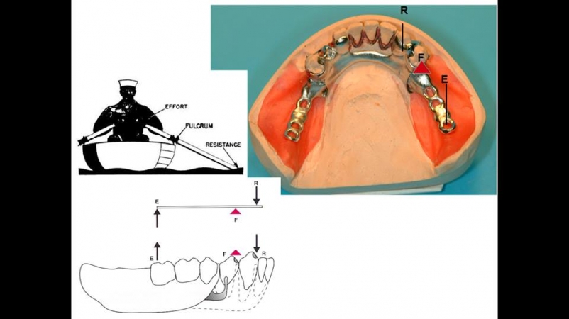 بعض المفاهيم الاساسية في التعويضات المتحركة Removable Partial Dentures