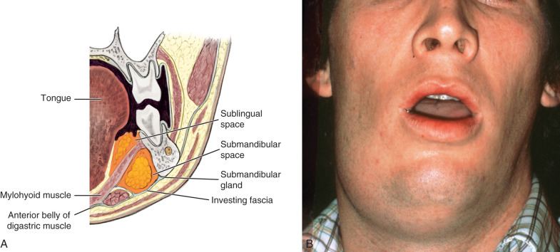 انتانات المسافات الوجهية Facial Space Infections