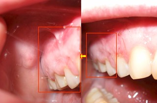 الأكياس التَّاجيَّة Dentigerous Cysts