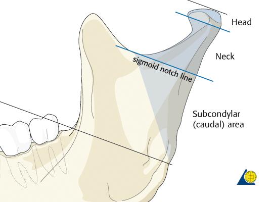 دلائل كسر اللقمة الفكية Condylar Fracture
