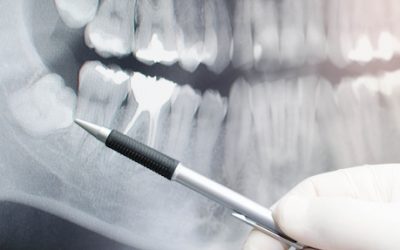 كسر السن أو السن المجاور أثناء قلع الأسنان – كيف نتصرف؟