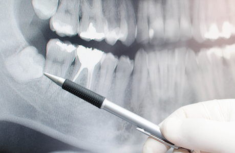 كسر السن أو السن المجاور أثناء قلع الأسنان – كيف نتصرف؟