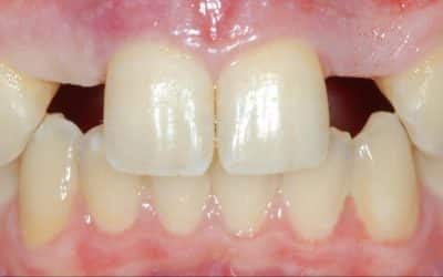 طرق علاج فقد الرباعيات Missing Lateral incisors