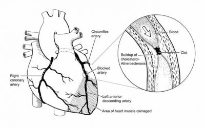 خناق الصدر واحتشاء العضلة القلبية Angina myocardial infarction