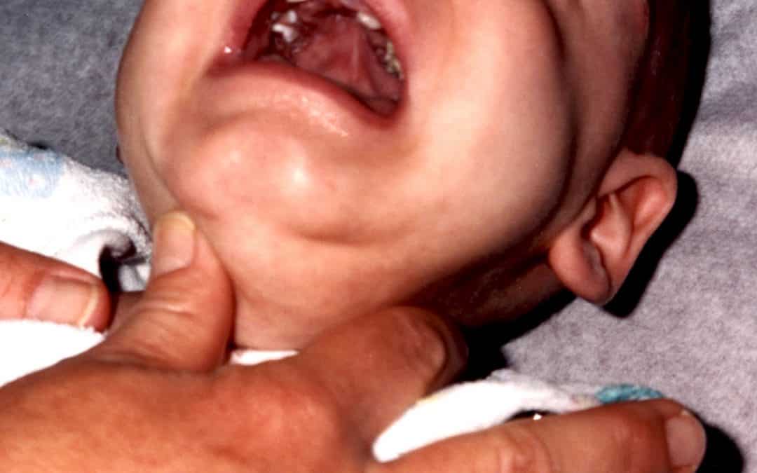 إضطرابات بزوغ الأسنان