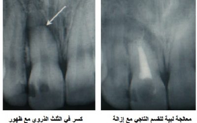 كسور الأسنان و تدبيرها لبياً