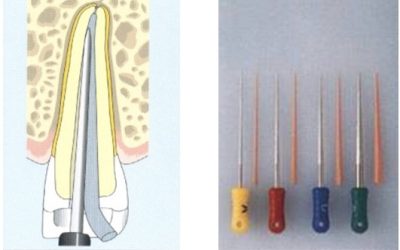 التكثيف الجانبي للكوتابركا Lateral Condensation of Gutta-percha