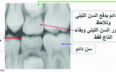 نقص الفيتامينات والمعادن يؤثر على أسنان الأطفال ..
