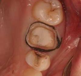 العلاقات المتبادلة بين النسج حول السنية والتعويضات Periodontal Restorative Interrelationships