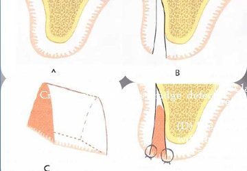 تقنيات الطعم المندخل ( الأسفين ) في إعادة بناء الحافة السنخية Interpositional Gragts