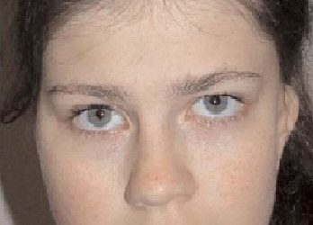 الجراحة التقويمية لتشوهات الوجه و الفكين