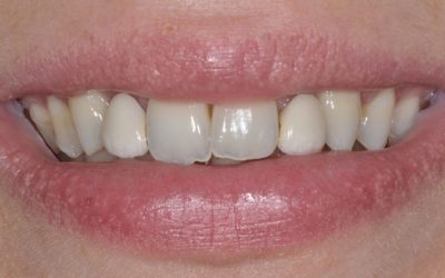 حفر الوصول أسنان أمامية علوية  Maxillary anterior access