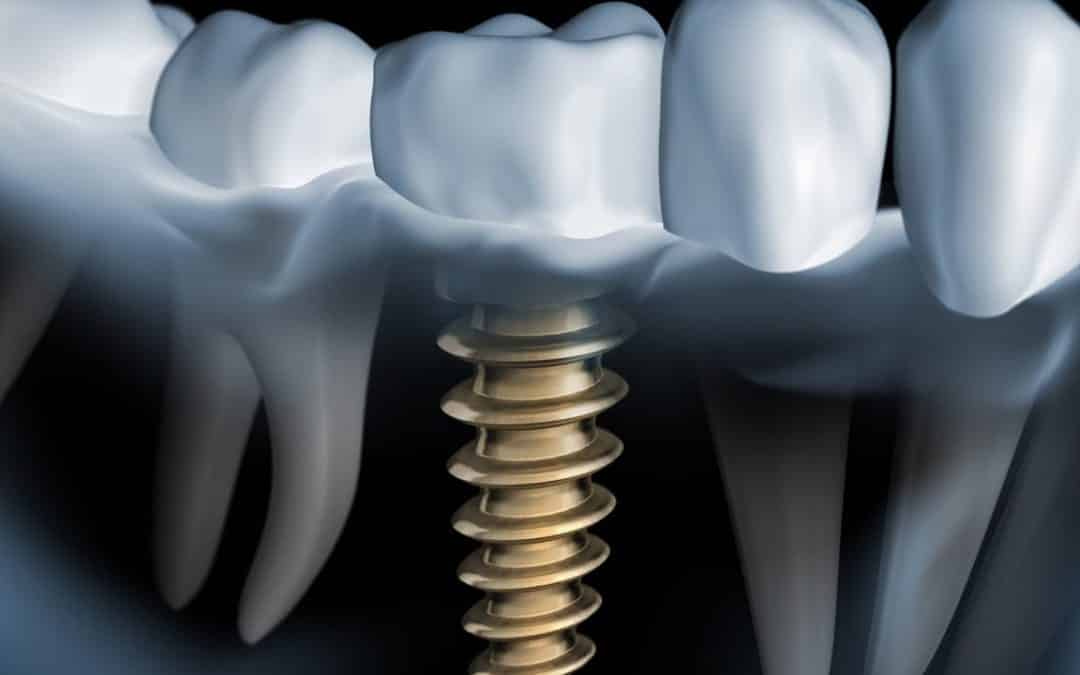 معايير نجاح وفشل زرعات الأسنان  بحث ماجستير