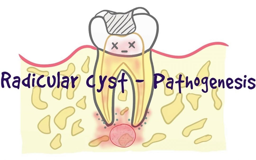 الكيس الجذري Radicular cysts