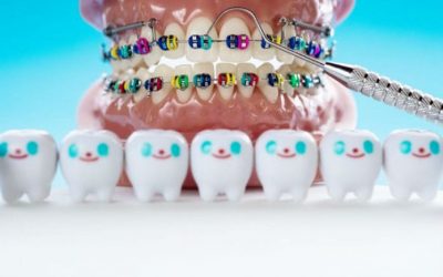 انواع المطَّاط التقويمي Elastics واستخداماته في تقويم الاسنان
