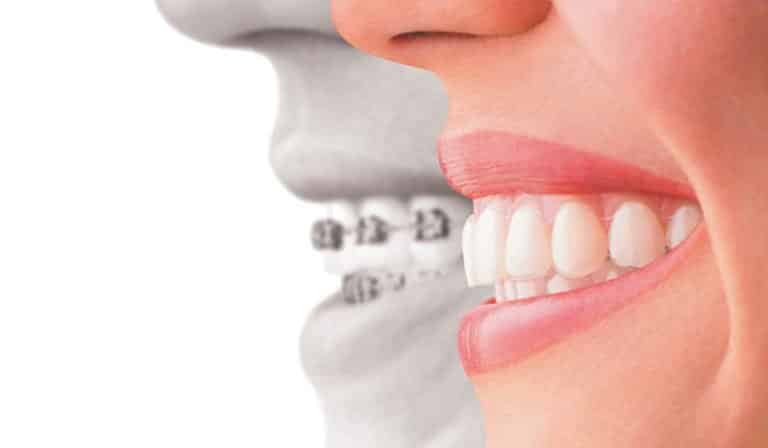 مشاكل اللسان والشفاه وتقويم الاسنان