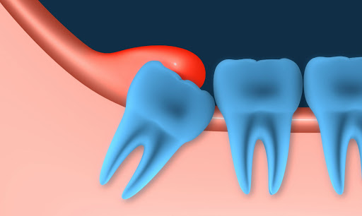 الأسنان المنطمرة والأسنان الزائدة