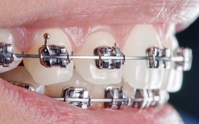 الحاصرات التقويمية Orthodontic Brackets أجزاءها وأنواعها