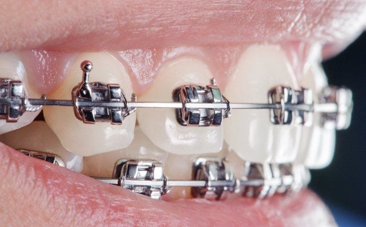 الحاصرات التقويمية Orthodontic Brackets أجزاءها وأنواعها