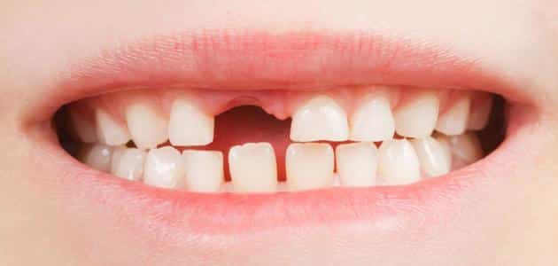 أهمية الأسنان المؤقتة عند الاطفال